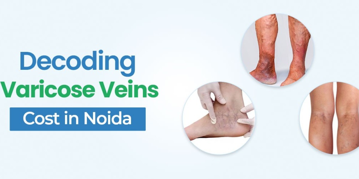 Decoding the Varicose Vein Surgery Cost in Noida