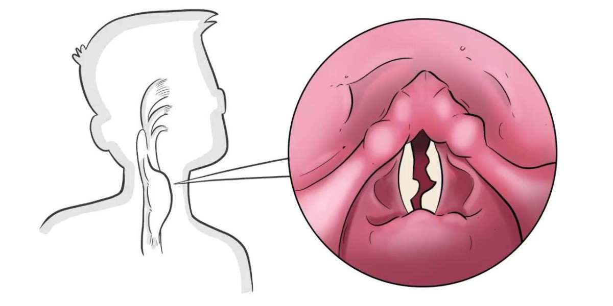 Vocal Cord Paralysis Treatment Market: Global Trends, Regional Outlook, and Growth Opportunities