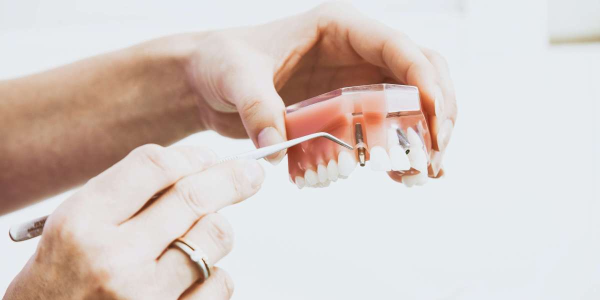 Beyond Dentures: Why Dental Implants Are Changing Lives