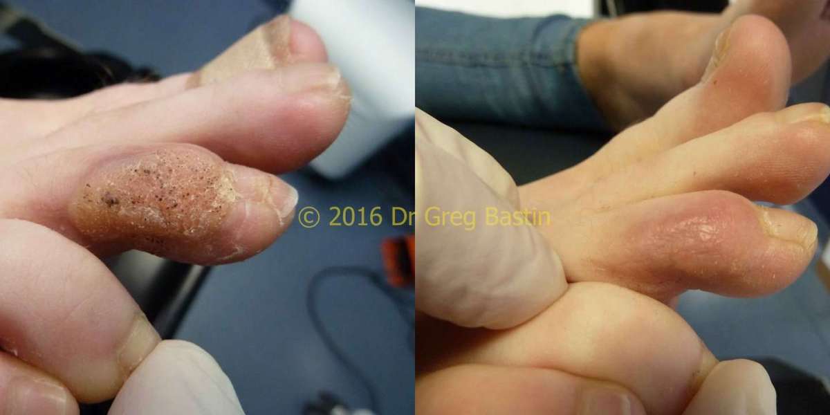 Personalized Treatment for Warts: Expert Care in Melbourne and Brighton