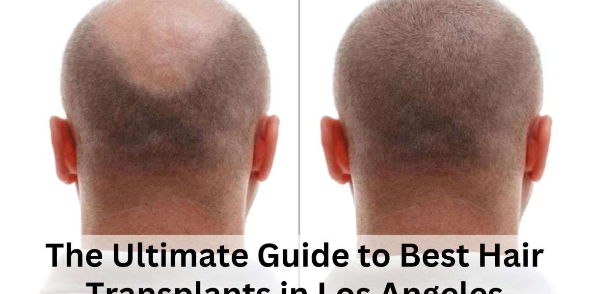 The Ultimate Guide to Best Hair Transplants in Los Angeles