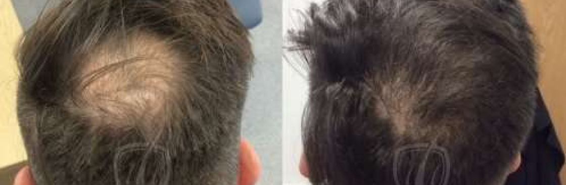 hairtransplantcost uk Cover Image
