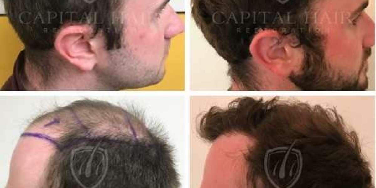 Investing In Your Appearance Hair Transplant Expenses In The Uk