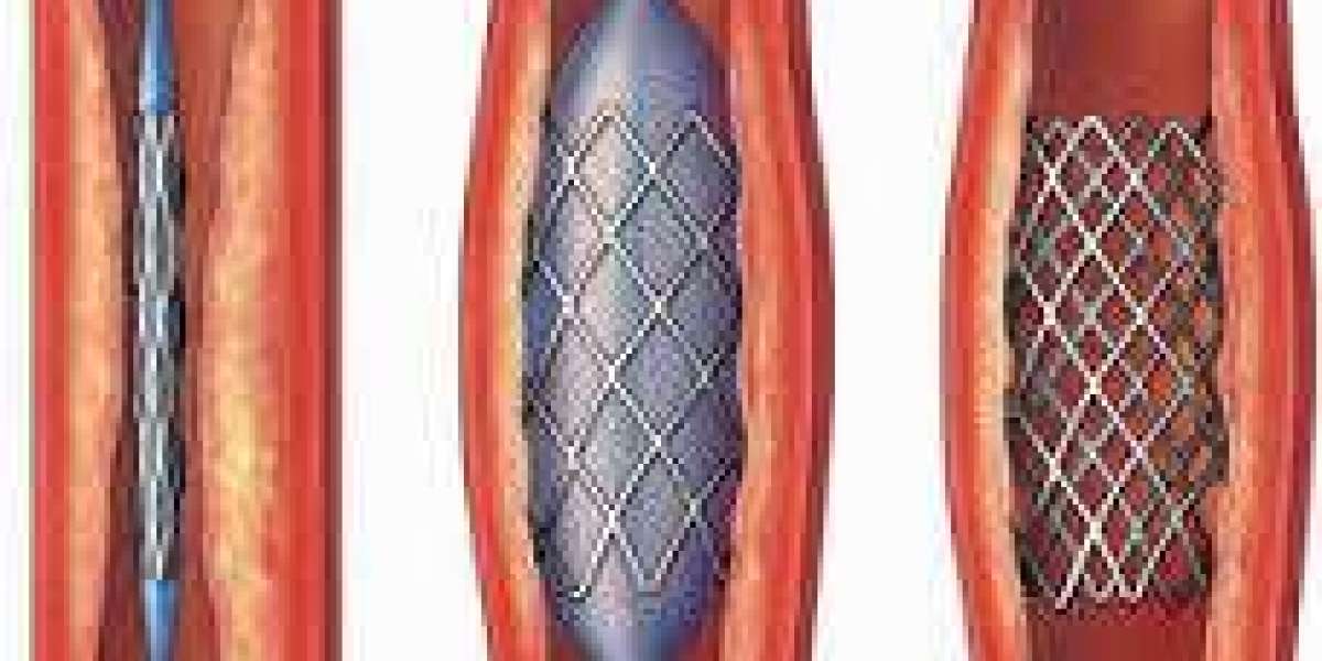 Comprehensive Angioplasty Solutions: Coronary, Carotid, and Peripheral Angioplasty in Bikaner