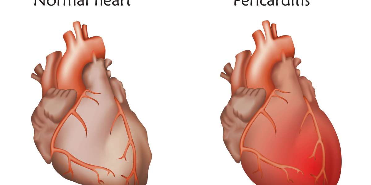 Exploring Pericarditis as a Lesser-Known Complication of Cancer