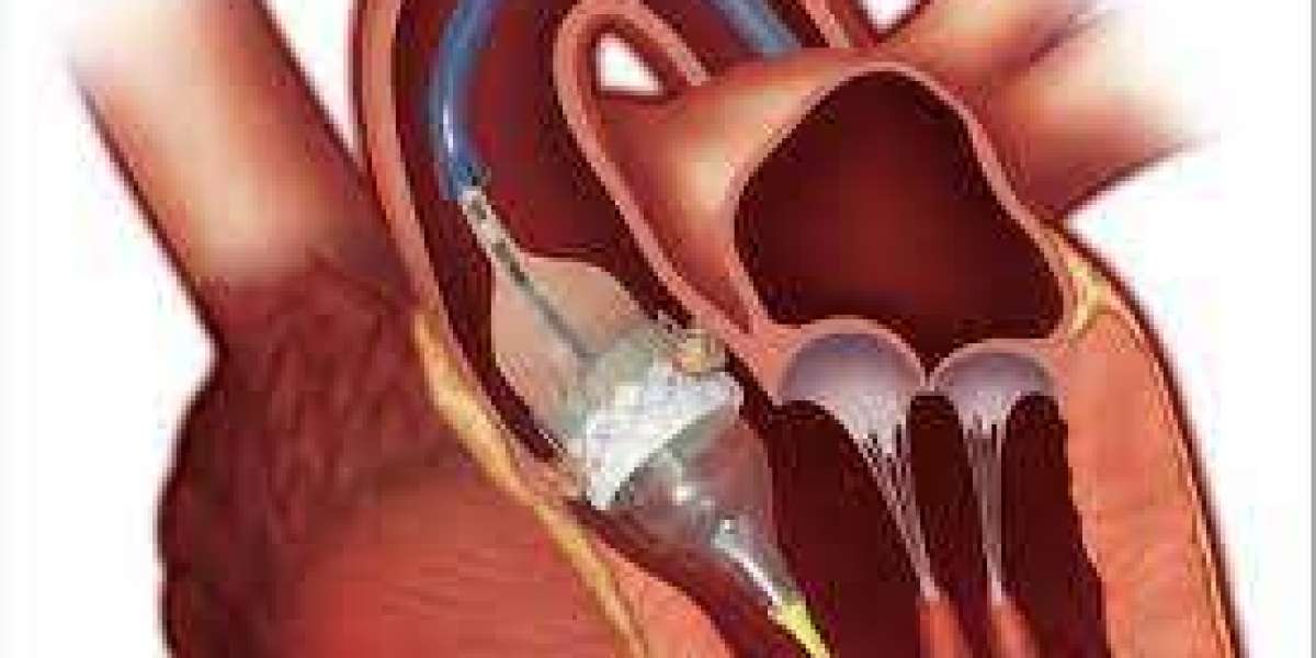 Navigating Cardiac Innovation: Transcatheter Aortic Valve Implantation (TAVI) in Jaipur