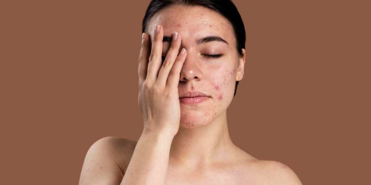 Acne Troubles: How Effective Is Homeopathic Medicine for Clear Skin?