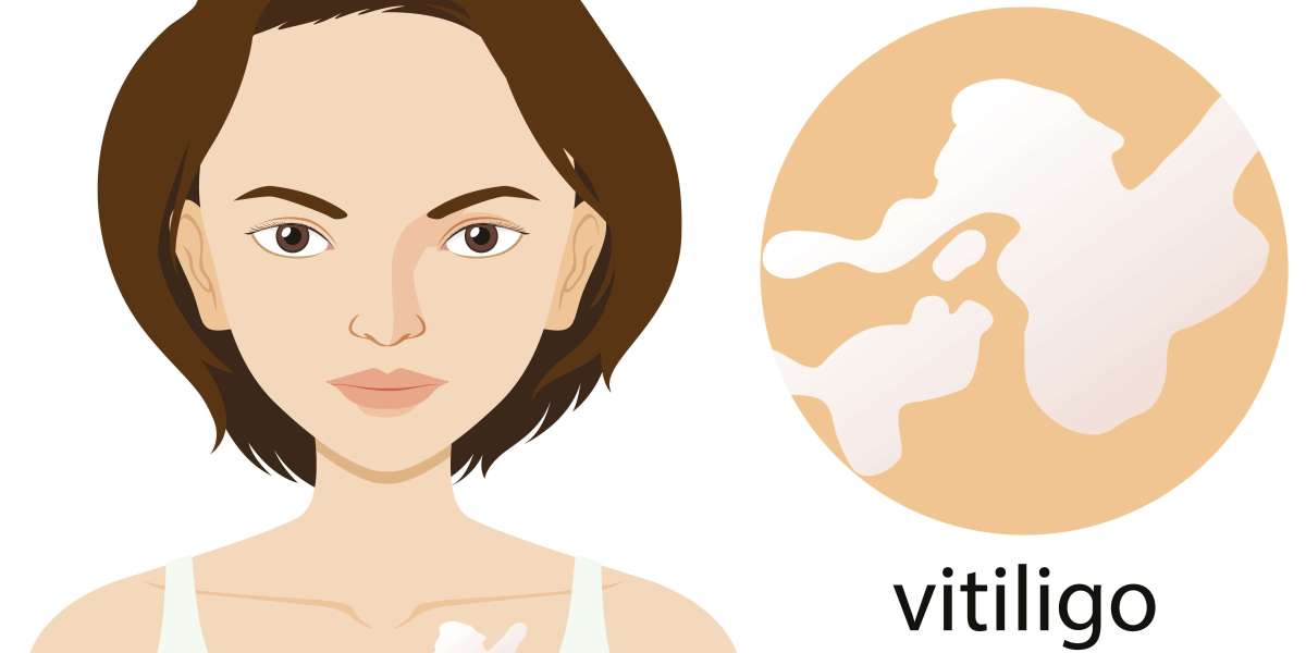 How Does Homeopathy Approach Vitiligo Treatment?   