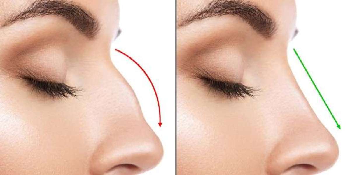 Exploring the Price Range for Nose Surgery in India