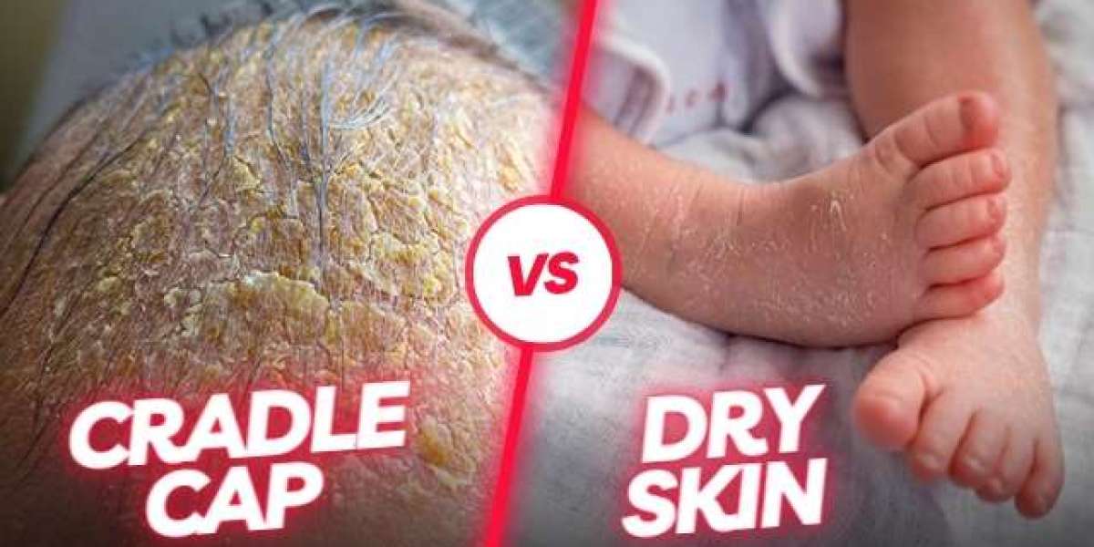 Cradle Cap vs. Dry Scalp: Clearing Up Confusion for Parents