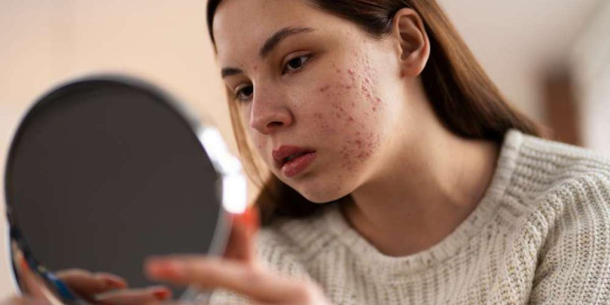 Pimples and Dark Spots: Can Homeopathy Offer a Clear Solution?