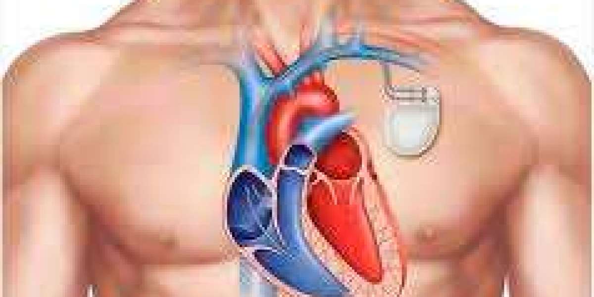 Pacemaker Implantation in Jaipur: A Lifesaving Intervention