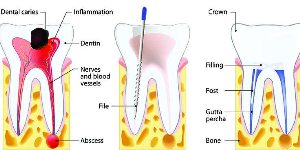 Detailed Step-By-Step Procedure Guide of Root Canal Treatment