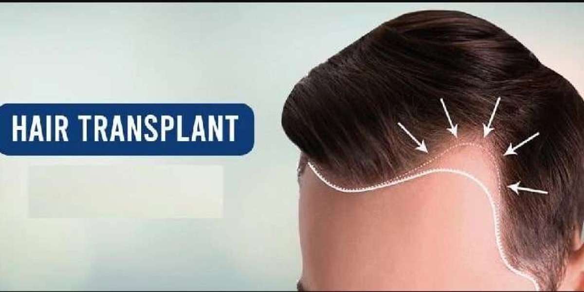 The Ultimate Guide to Hair Transplant in Chhattisgarh: What to Expect