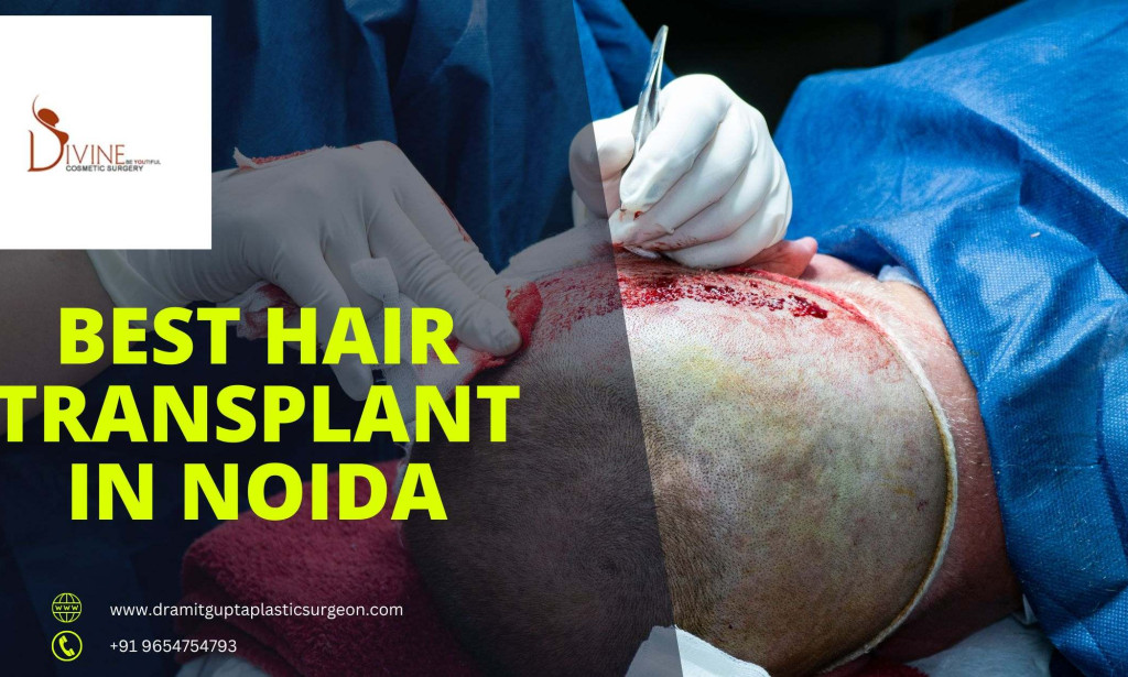 Will Hair Transplant Restore The Original Density Of Hair top?