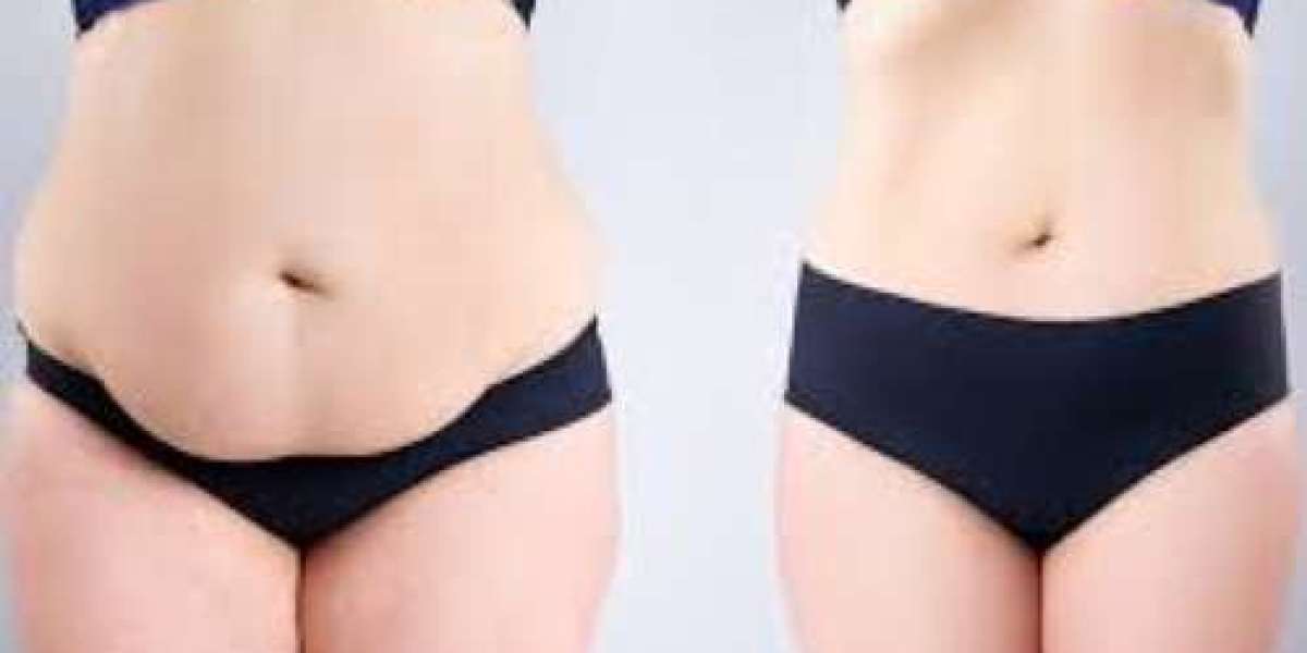What to Expect from Tummy Tuck Surgery in Dubai