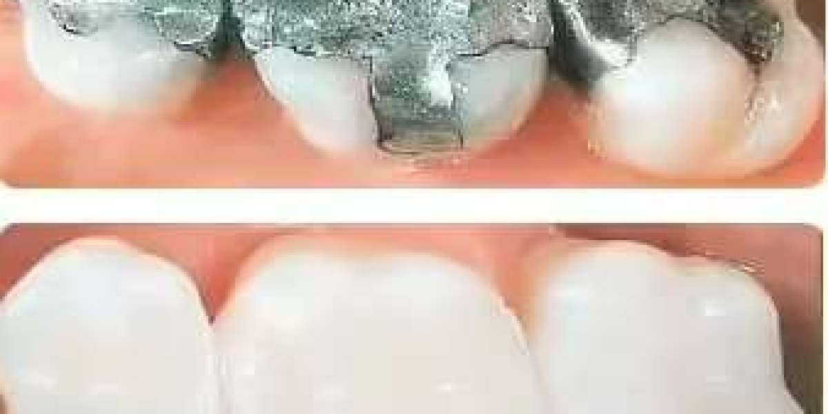 Effective Tooth Filling Services at ABCD Clinic