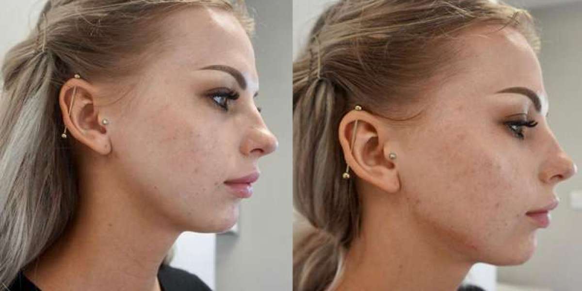 Before and After: Jawline Filler and Cheek Filler Transformations in 2024