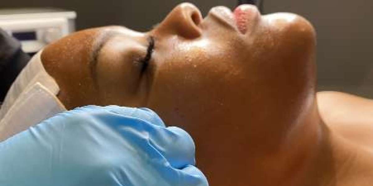 Microneedling: Transforming Skincare in The Woodlands, TX