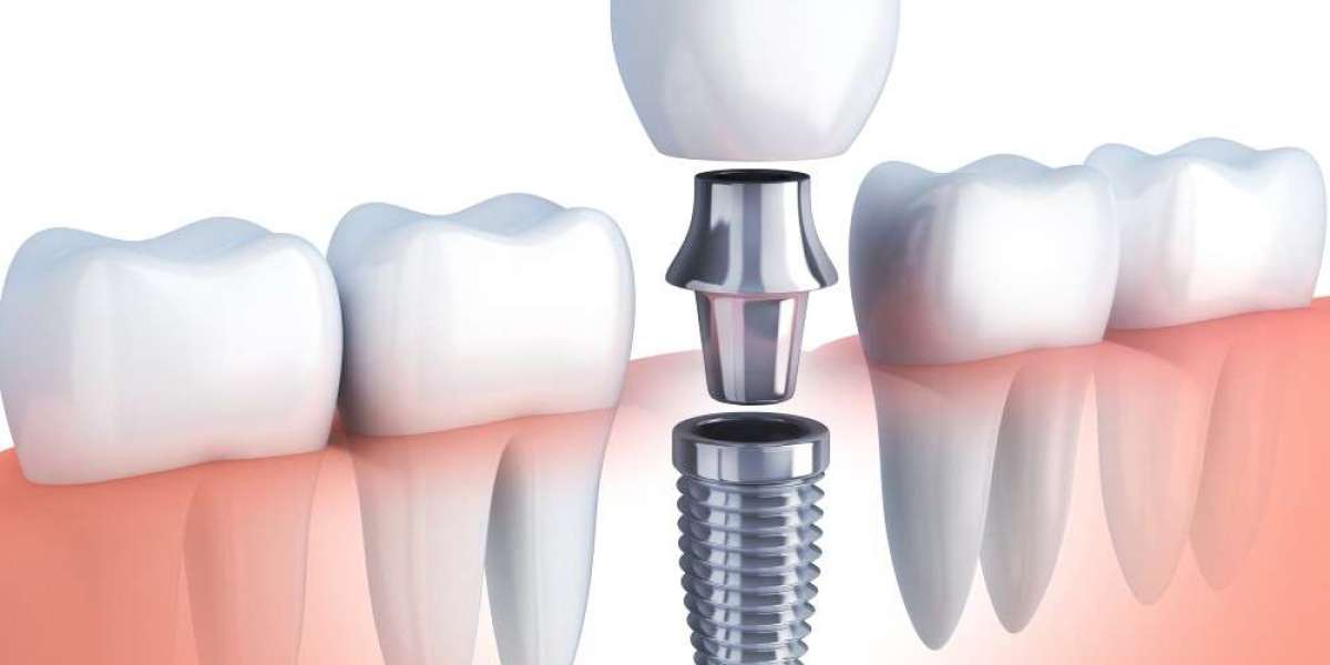 Dental Implant Surgery: What is it and Why is it Done?