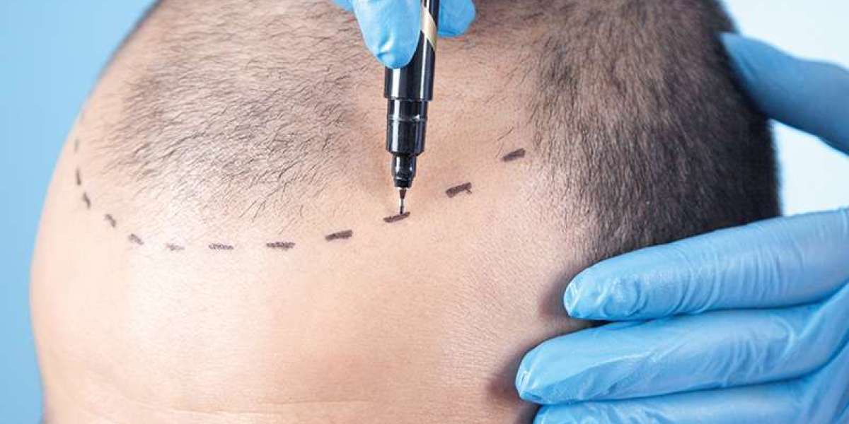 The Complete Guide to Turkish Hair Transplant in Dubai