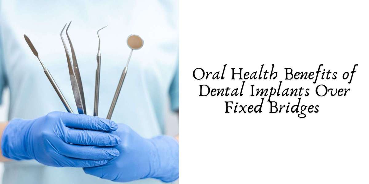Oral Health Benefits of Dental Implants Over Fixed Bridges