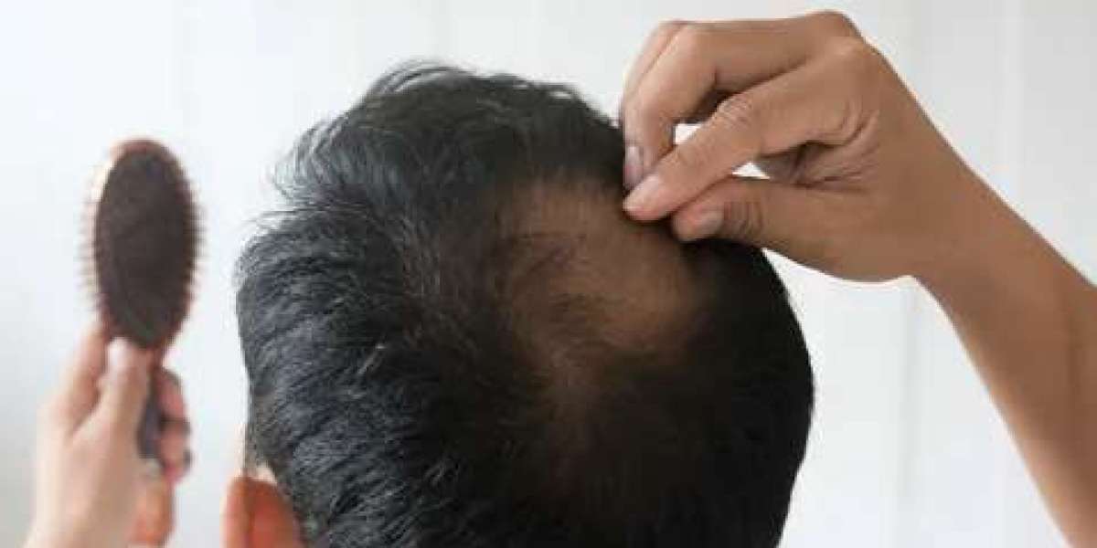 Comparing Hair Transplant Techniques in Abu Dhabi