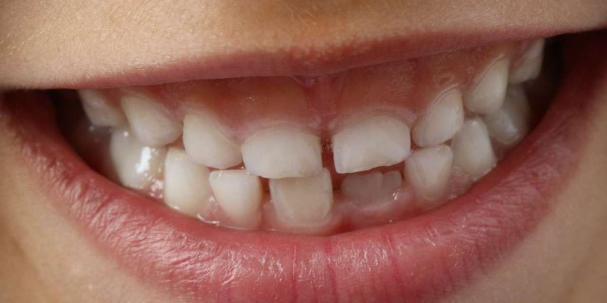 How Missing Teeth Affect Your Jawbone and Facial Structure