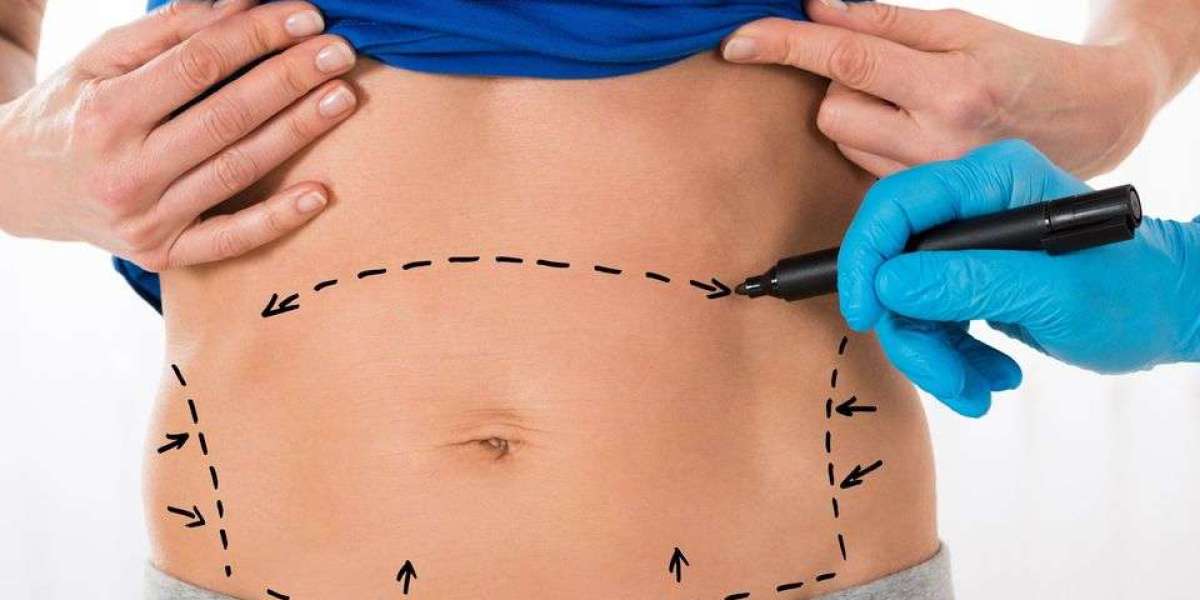 Transform Your Life with a Tummy Tuck