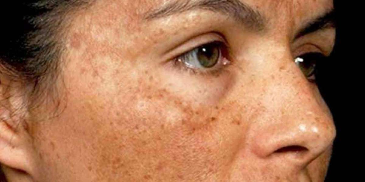 Advances in Modern Pigmentation Disorders Treatment Options