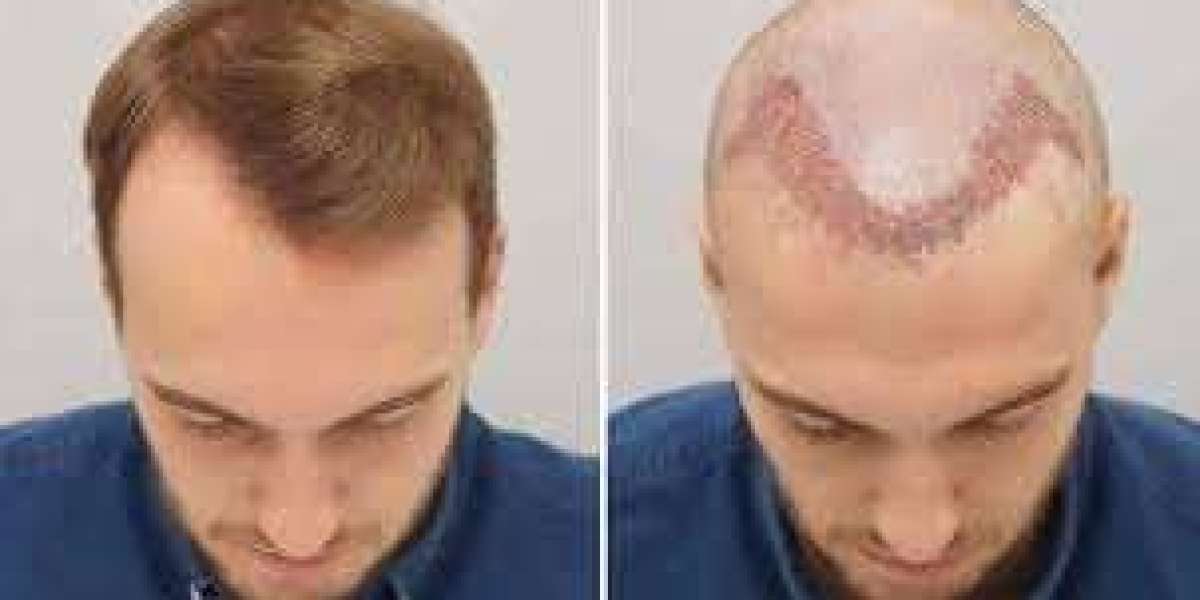 Dubai’s Hair Transplant Revolution: Achieve Your Ideal Look