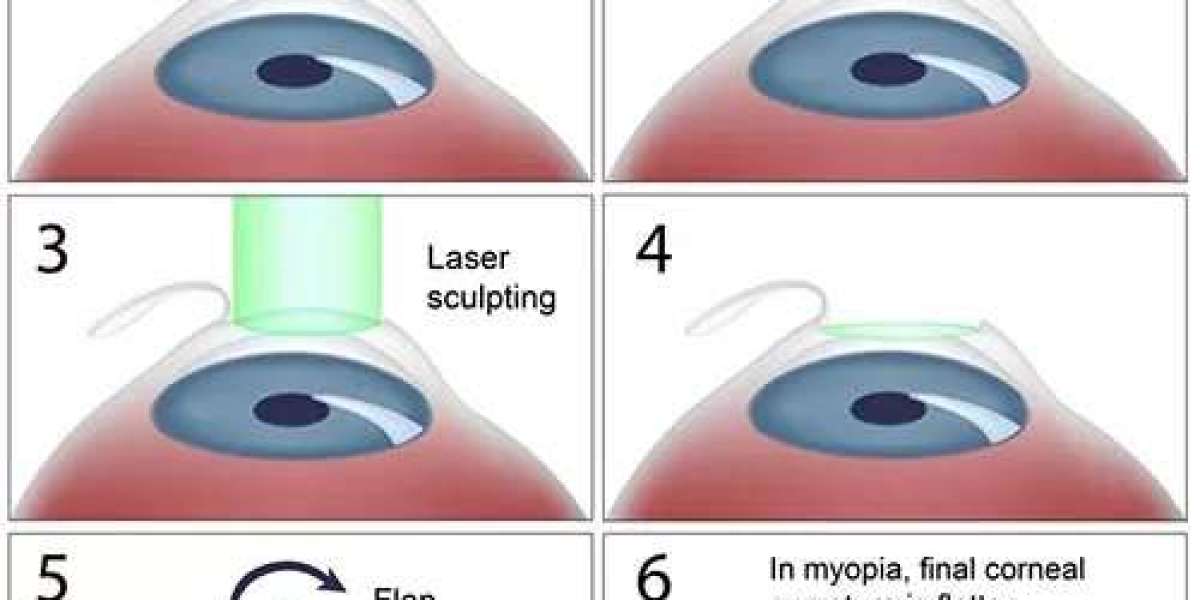 LASIK Eye Surgery: Specialties and Advantages at Eye-Q India