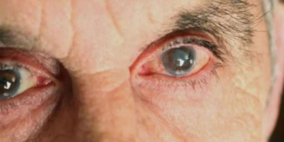 Global Age-Related Macular Degeneration Market Trends, Growth, Share, Outlook & Forecast | 2024 - 2032