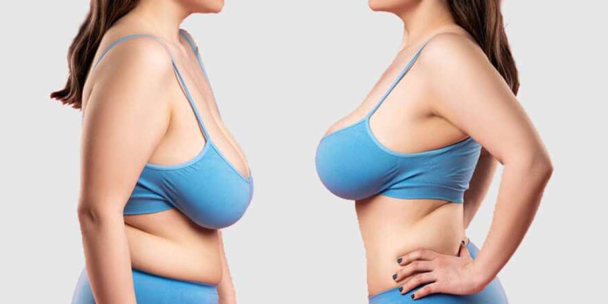 Comprehensive Guide to Breast Reduction Surgery in Delhi