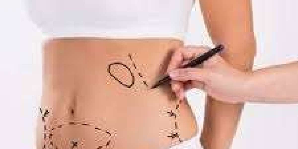 Liposuction in Riyadh: Precision and Art in Body Contouring