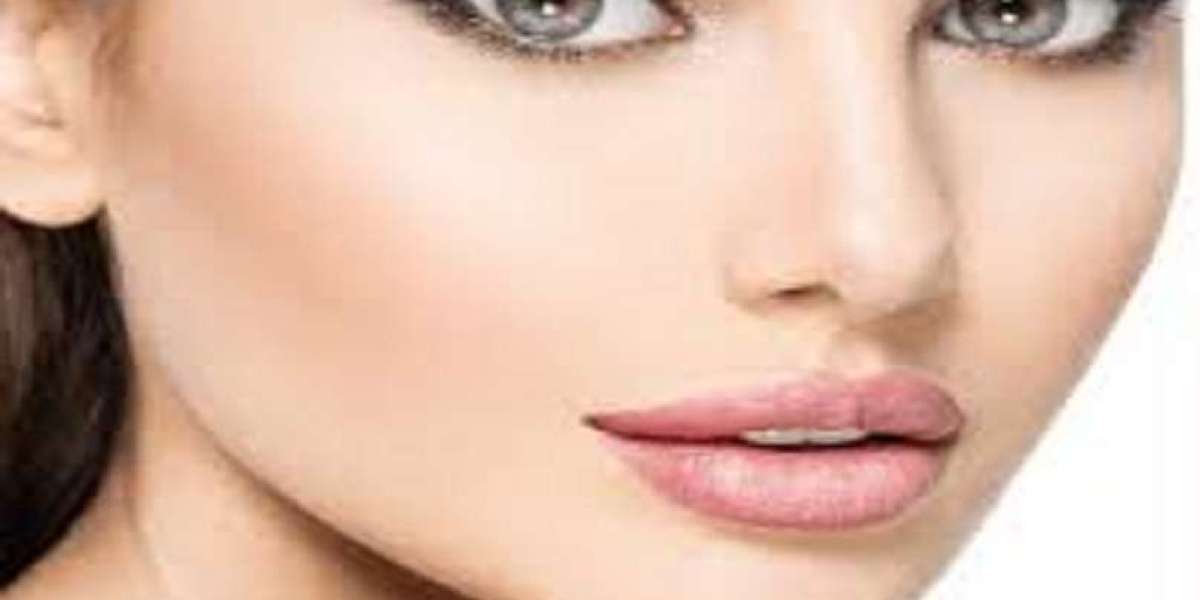 "Juvederm for Smile Lines: Softening Deep Nasolabial Folds"