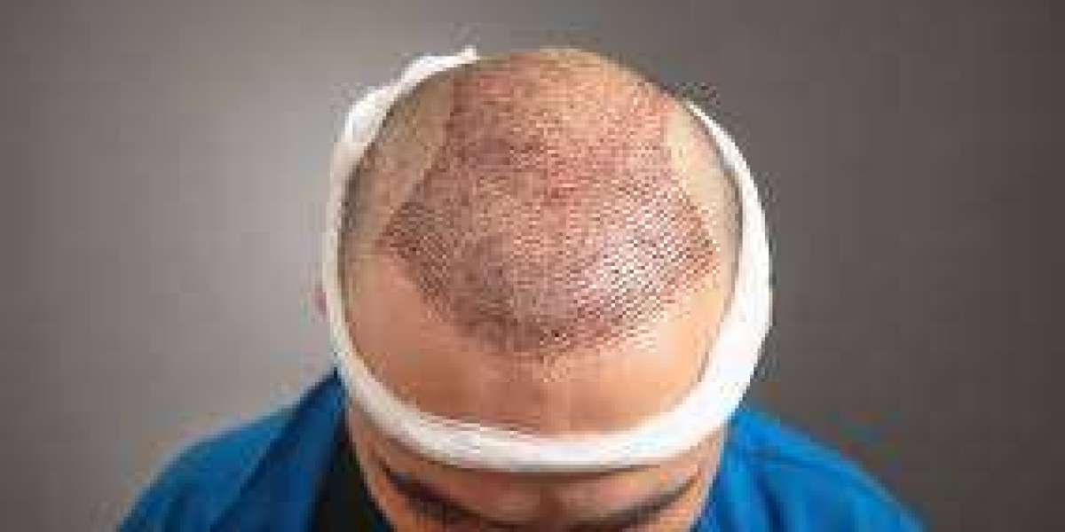 Experience Cutting-Edge Hair Restoration in Riyadh